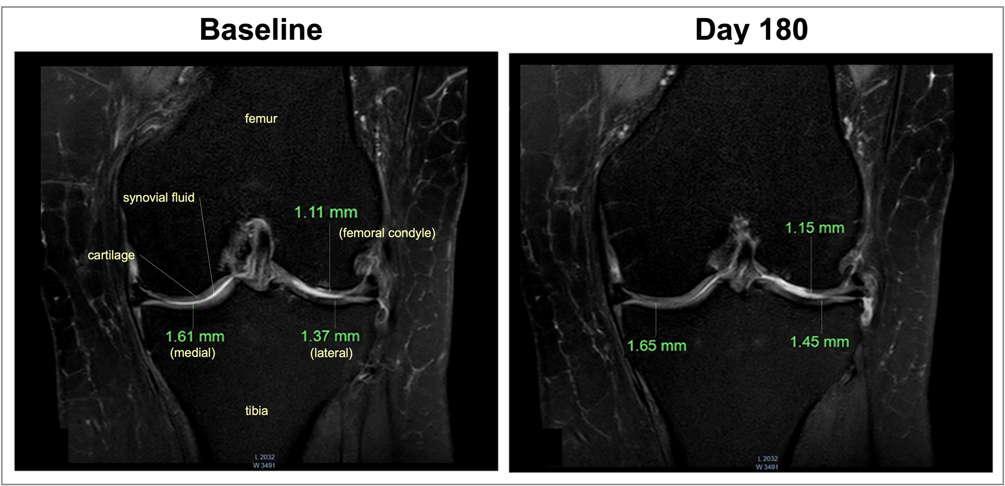 femoral-cartilage-thickness-apresflex-mri-study