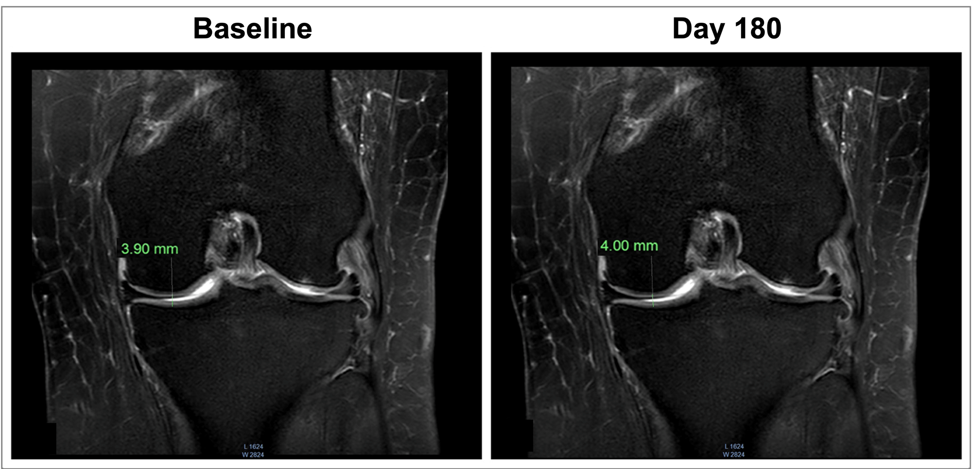 joint-space-mri-image-apresflex-study