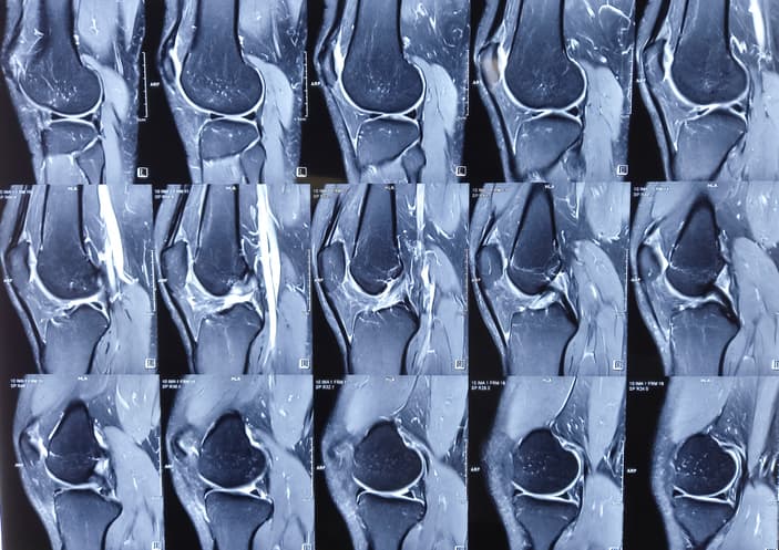 MRI of Knee